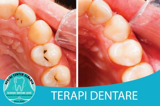 Terapi dentare endodonti Lezhe nga DENTAL CENTER LEZHA